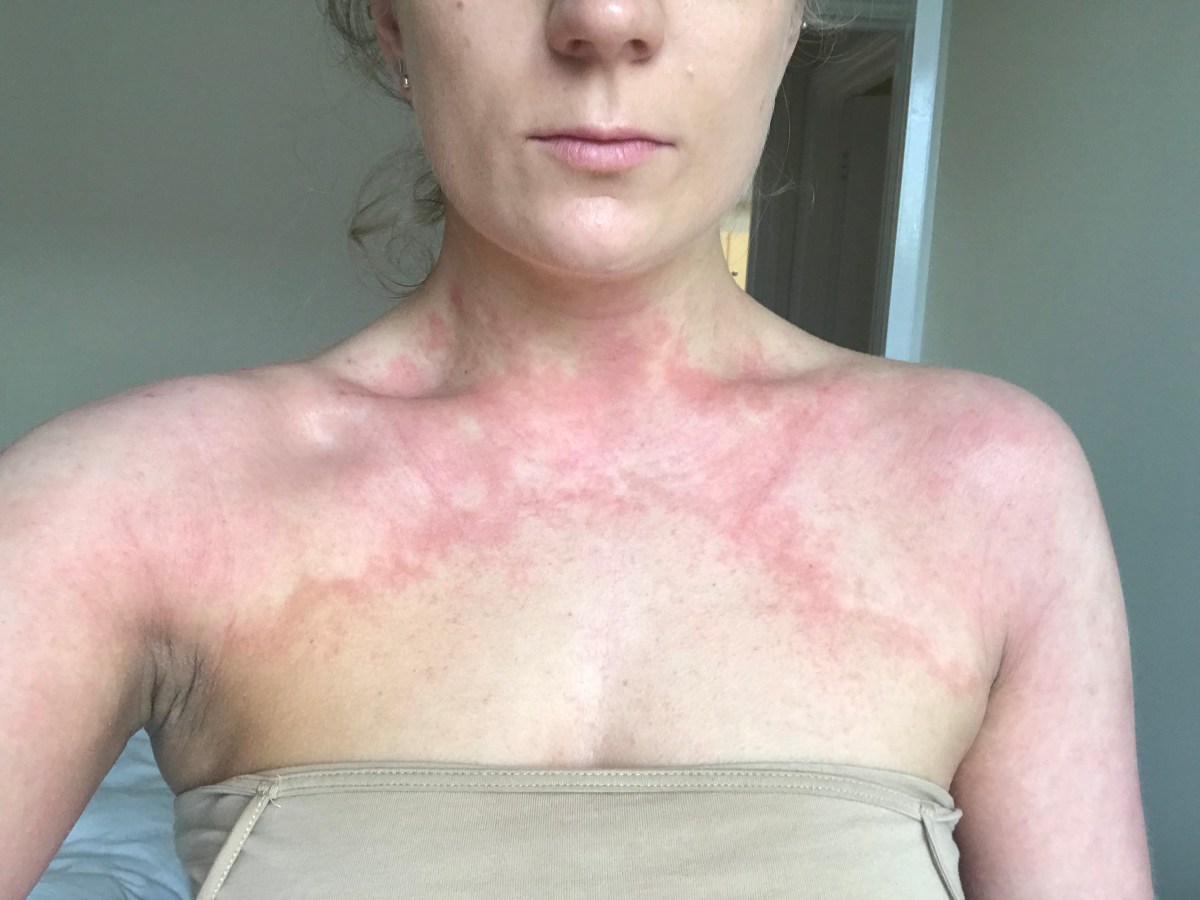 It’s Not Easy Being Itchy: Growing Up With&nbsp;Eczema